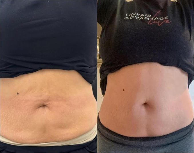 Stomach: before and after TShape2