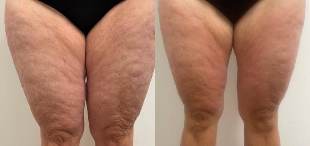 Cellulite on the thighs: before and after TShape2