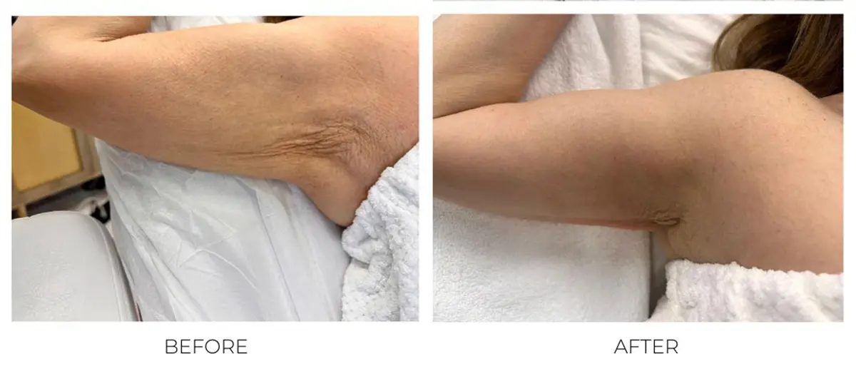 Loose skin on the upper arms: before and after TShape2