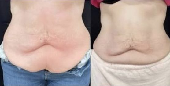 Loose skin on the lower stomach: before and after TShape2