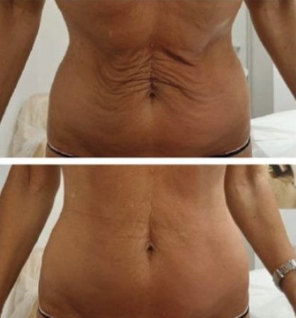 Loose skin on the stomach: before and after TShape2