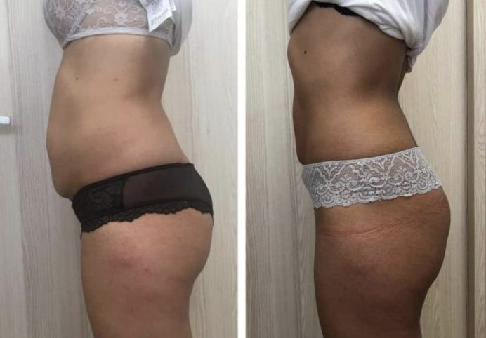 Stomach and waist from the side: before and after TShape2
