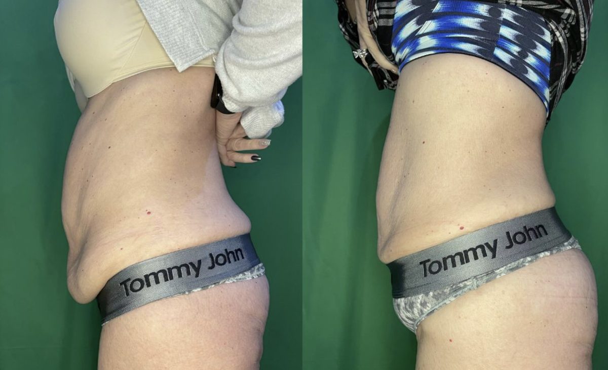 Lower stomach from the side: before and after TShape2