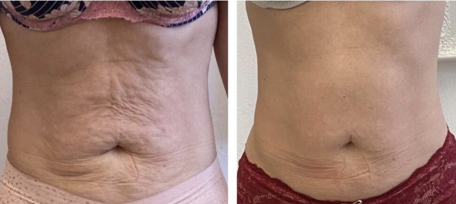 Loose, crepey skin on the stomach: before and after TShape2